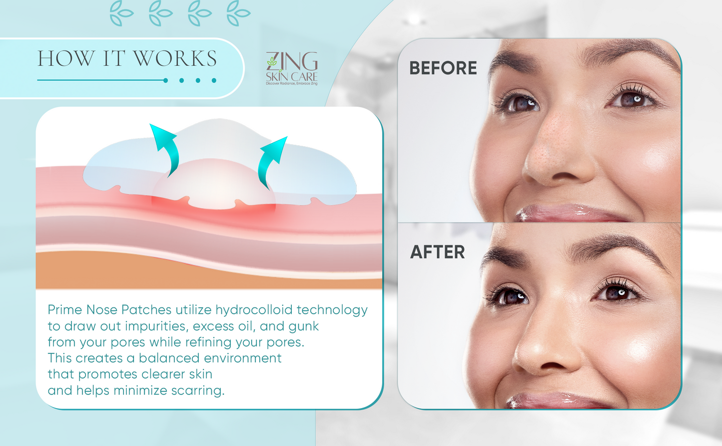 Nose Patch-Hydrocolloid Patch for Nose